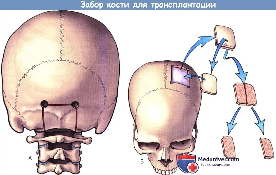 Трансплантата теменной кости. Забор трансплантата теменной кости. Пересадка кости