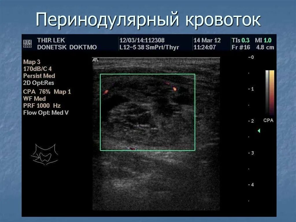 Могут ли узлы щитовидной железы рассосаться. Интранодулярный кровоток узла щитовидной. Перинодулярный кровоток узла щитовидной усилен. Типы кровотока в узлах щитовидной железы. Типы васкуляризации щитовидной железы по УЗИ.