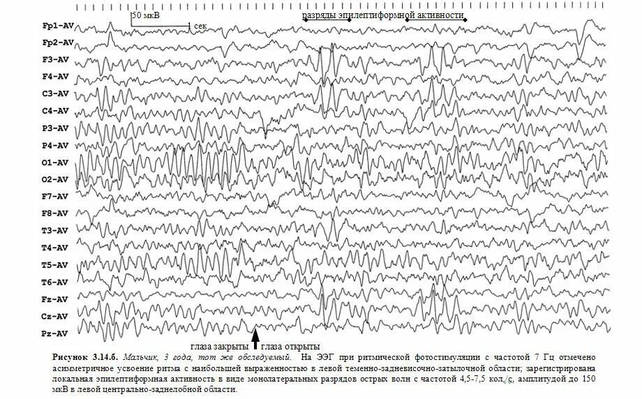 Эпилептиформная активность на ээг у ребенка. Эпилептиформная активность на ЭЭГ. Эпилептиформные феномены на ЭЭГ что это. Синдром Ретта ЭЭГ. Тонический приступ ЭЭГ паттерн.
