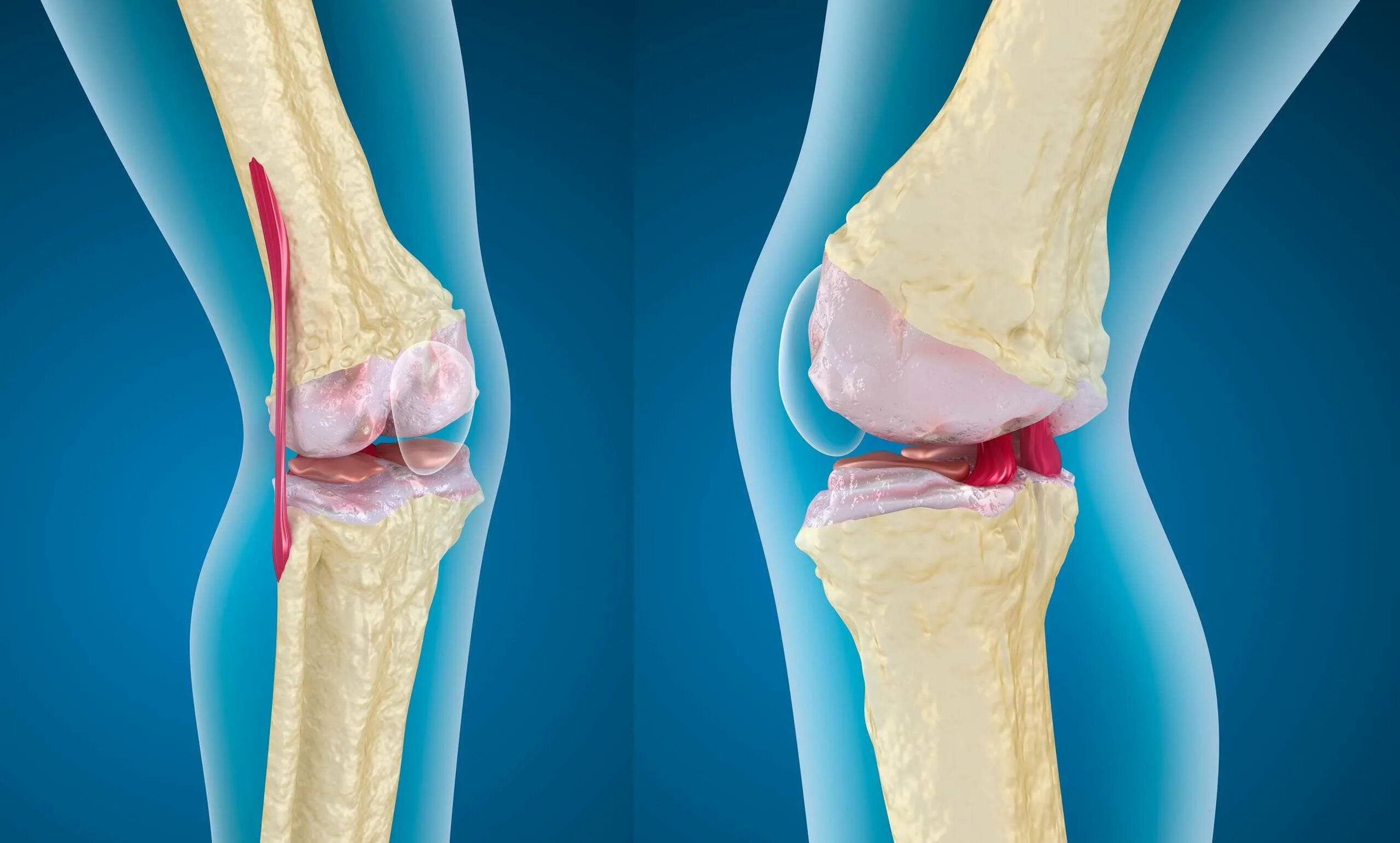 Эффективное лечение артроза сустава. .Деформирующий остеоартрит остеоартроз. Деформирующий остеоартроз коленного. Деформирующий артроз и артроз.