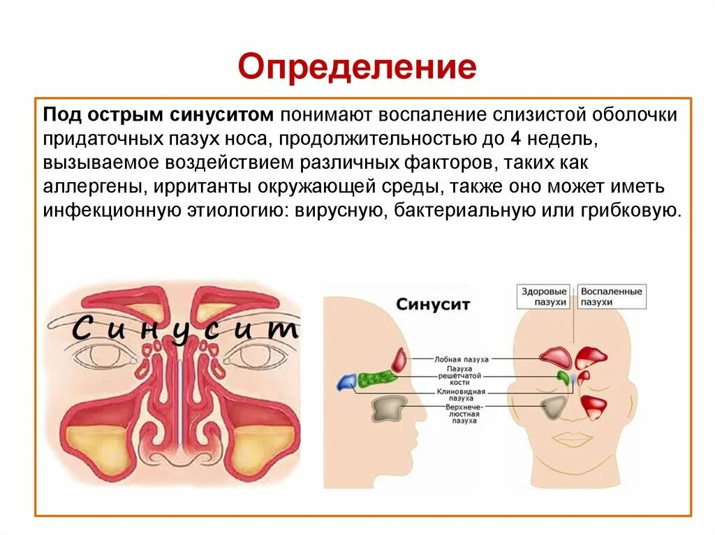 Синусит. Острый бактериальный синусит. Острый ринит синусит бактериальный. Клинические симптомы синусита. Острый бактериальный синусит симптомы.