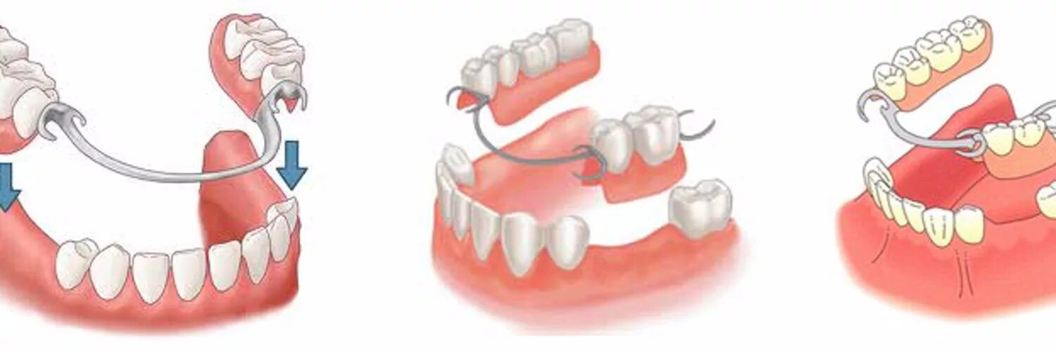 Частичный бюгельный протез зубов. Съемные протезы жевательных зубов. 3 зуба установить