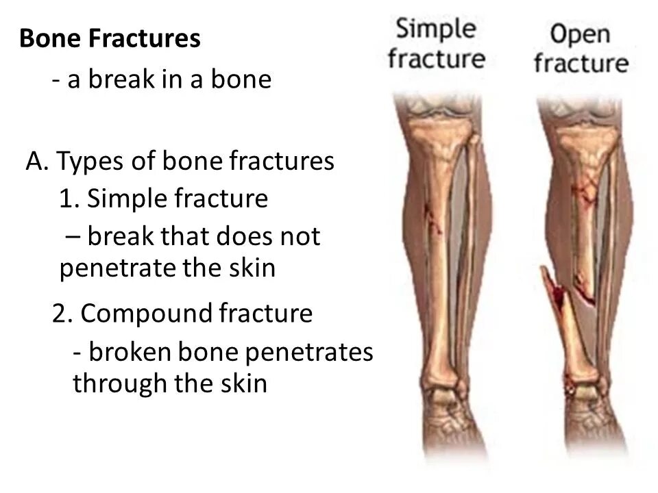 Перелом кости может быть каким. Bone Fracture is.