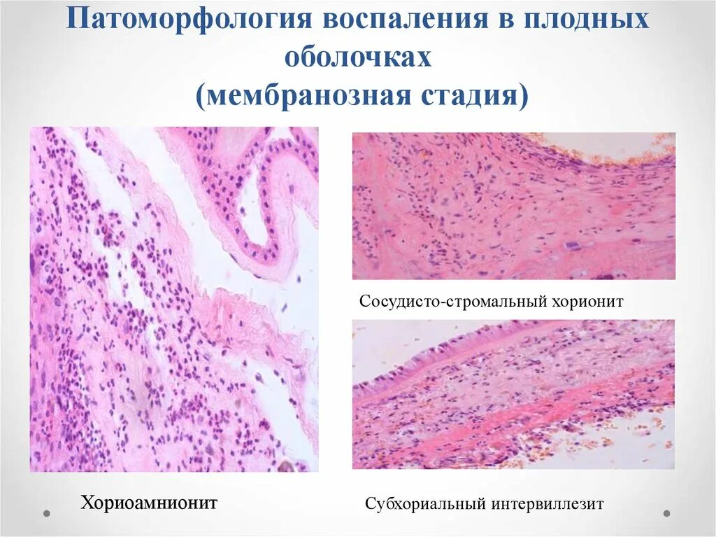 Плеоморфная аденома патанатомия. Histology masson. Гидропическая дистрофия печени. Серозный децидуит гистология. Серозный децидуит что.