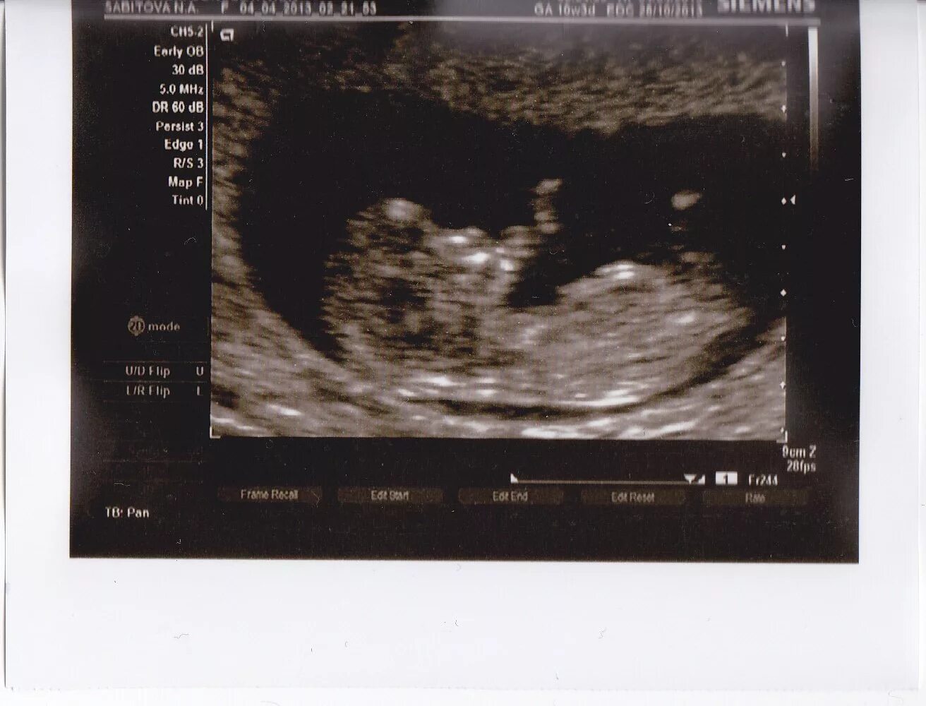 Снимок УЗИ 11 недель. УЗИ 11 недель беременности. УЗИ на 11 неделе беременности на УЗИ. Снимок УЗИ 11 недель беременности.