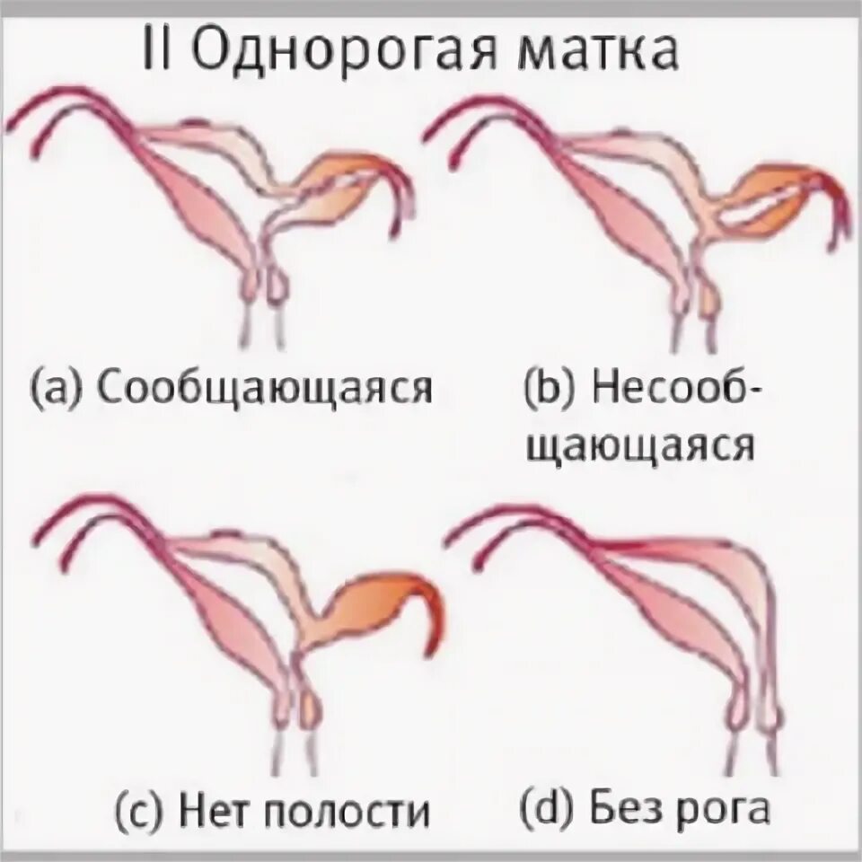 Может быть две матки. Аномалии развития матки классификация. однорогая матка с замкнутым рудиментарным рогом. аномалии строения матки.