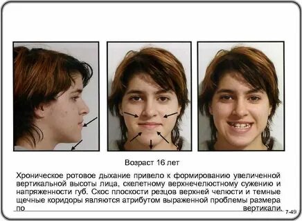 Ротовое дыхание