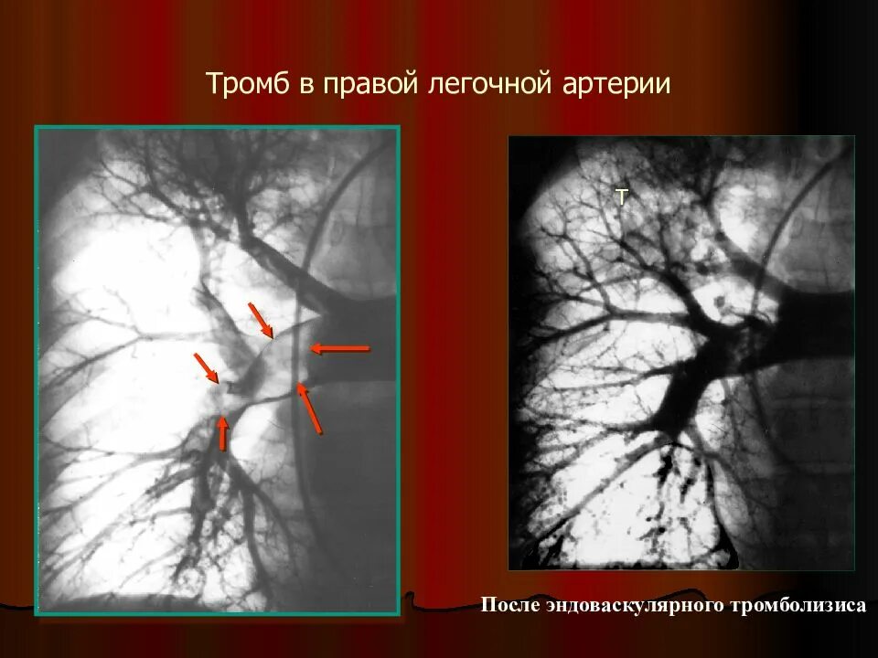 Тромб в артерии симптомы. Ангиопульмонография Тэла. Эмболии легочной артерии кт. Тэла тромболизис.