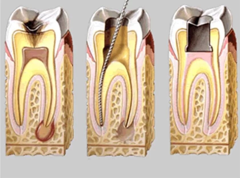 Воспаление канала зуба. Трехканальный пульпит. Пульпит одноканального зуба. Пульпит трехканального зуба.