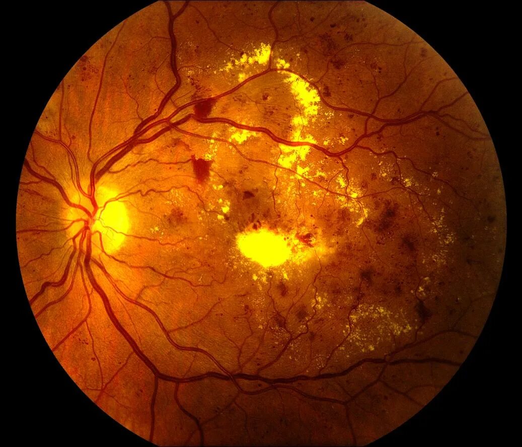 Болезнь глазного дна. Атеросклеротическая ретинопатия. Диабетическая ретинопатия сетчатки глаза. Ишемическая ретинопатия.