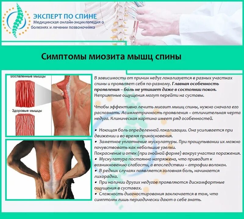 Повышаем температуры мышц. Воспаление мышц миозит. мышечный миозит поясницы.