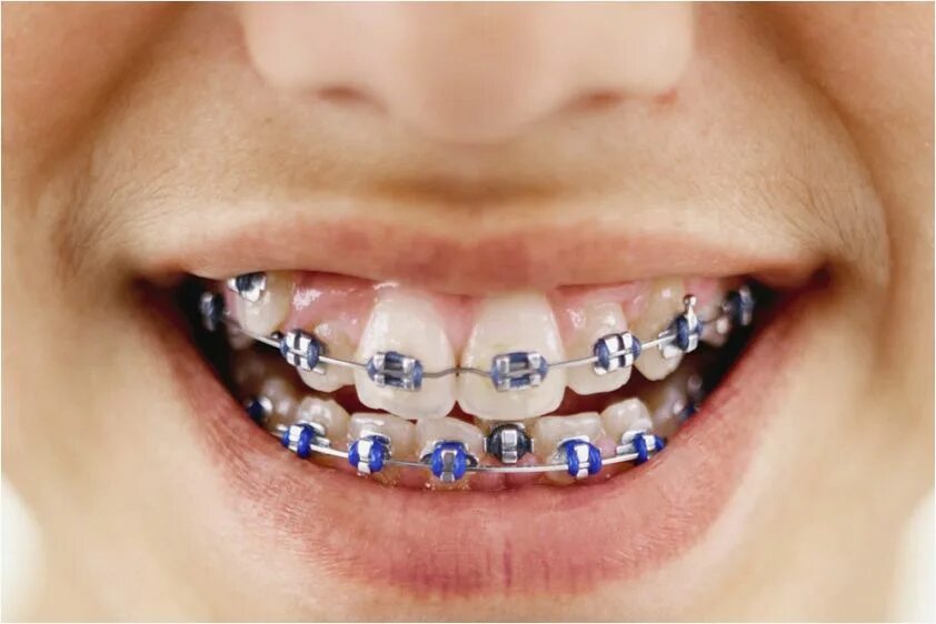 Ortho technology брекеты. Брекеты керамические и металлические. Брекеты американ ортодонтикс. Сколько стоят брекеты под ключ. Керамическая брекет система.