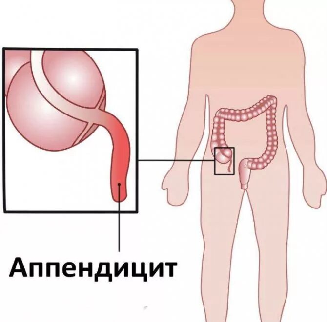 Аппендикс относится. Где находится аппендицит. Где находится аппендик.