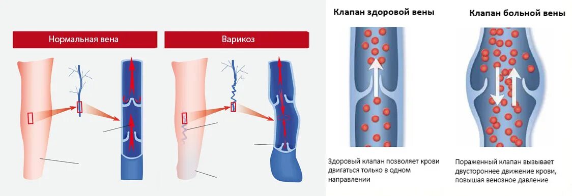 Вены ног клапаны. Схема работы венозных клапанов. Строение вен нижних конечностей клапаны. Строение варикозных вен. Варикозное расширение вен нижних конечностей анатомия.