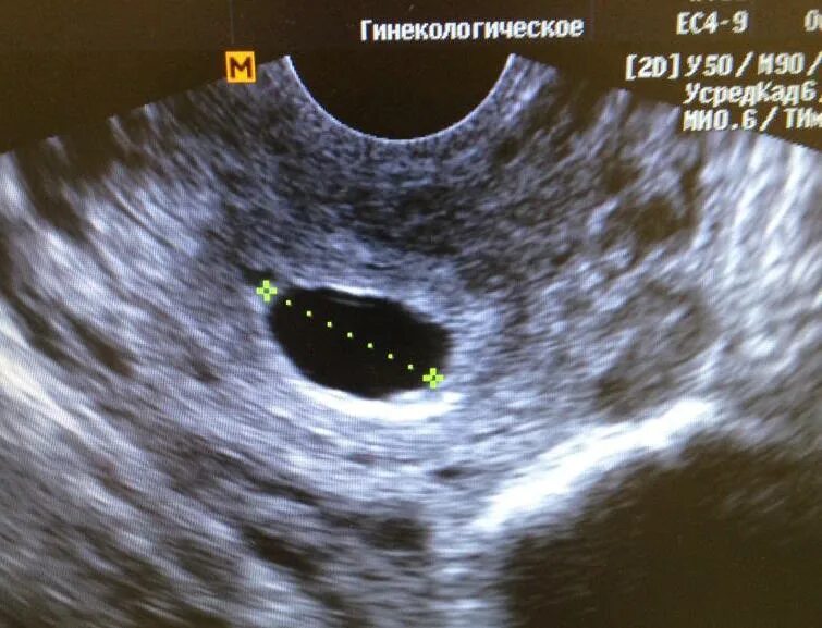 Медикаментозный аборт плодное яйцо. УЗИ после медикаментозного аборта. Плодное яйцо после медикаментозного аборта. Медикаментозное прерывание беременности плодное яйцо.