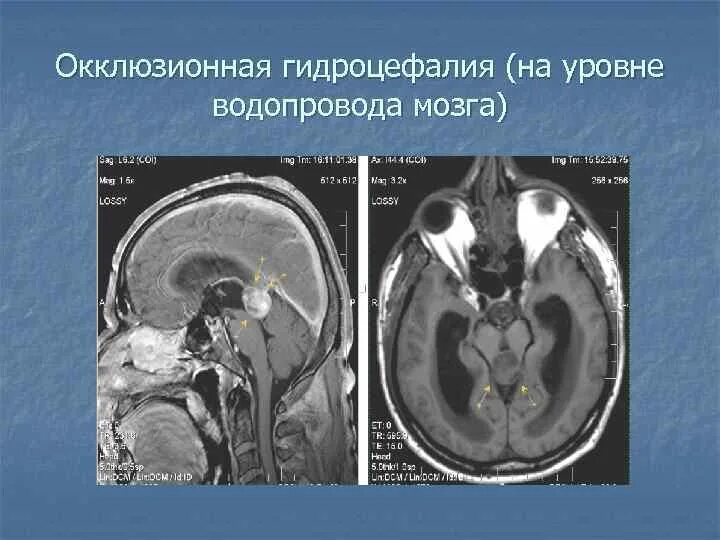 Выраженная заместительная гидроцефалия. Арезорбтивная гидроцефалия головного мозга.