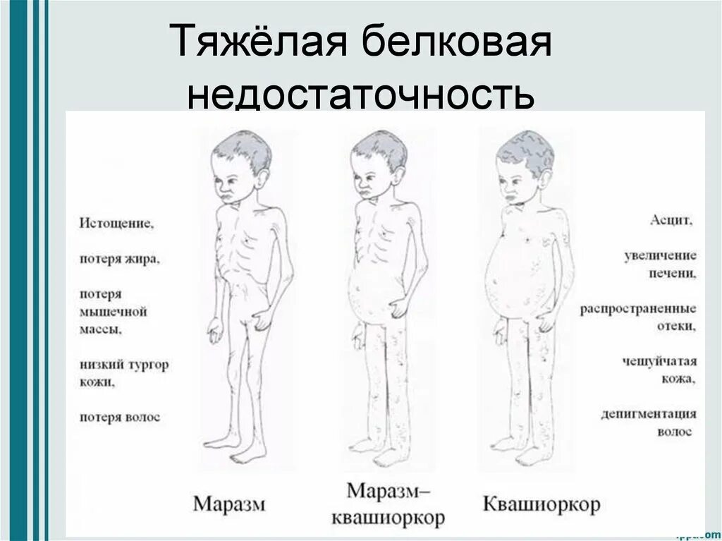 Белковая болезнь. Белковая недостаточность заболевания. Белковая недостаточность последствия. Недостаток белка в организме. Недостаток белка в организме болезни.