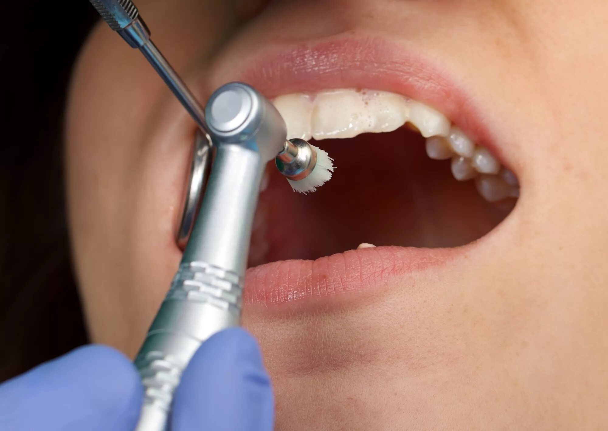 Профессиональная чистка зубов в стоматологии. Профгигиена (ультразвук + Air-Flow). Профгигиена полости рта. Проф гигиента полости рта. Профгигиена полировка зубов.