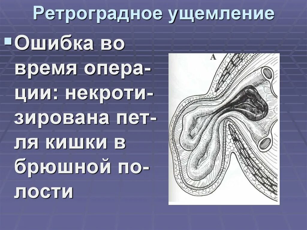 Эмболэктомия бедренной артерии. Ретроградное пломбирование верхушки корня. Ретроградное пломбирование корневых каналов. Ретроградный корень. Ретроградное пломбирование верхушки корня.
