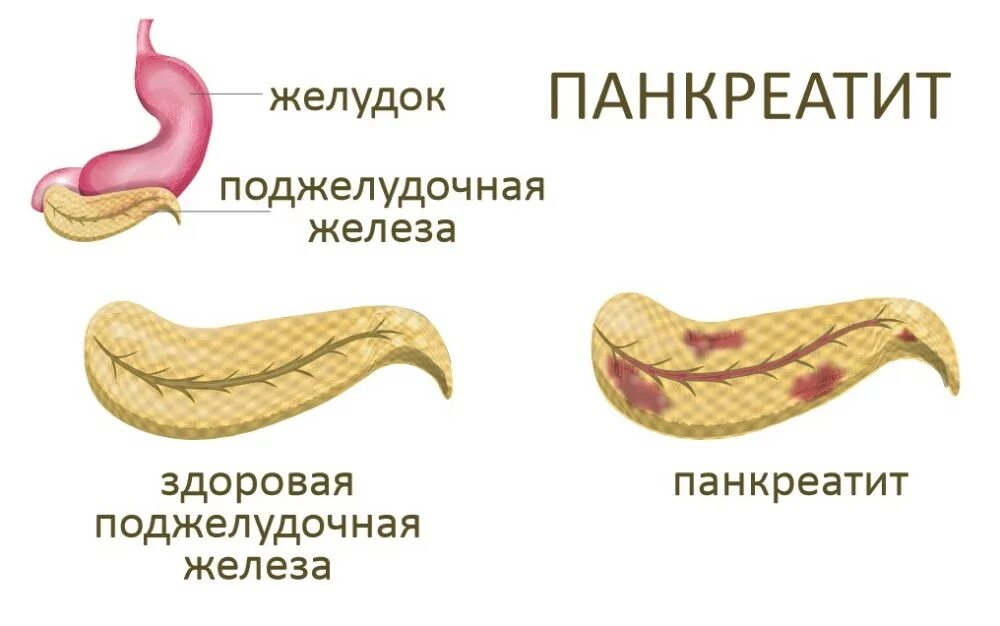 Приступ панкреатита. Хронический панкреатит. Панкреатит что развивает.