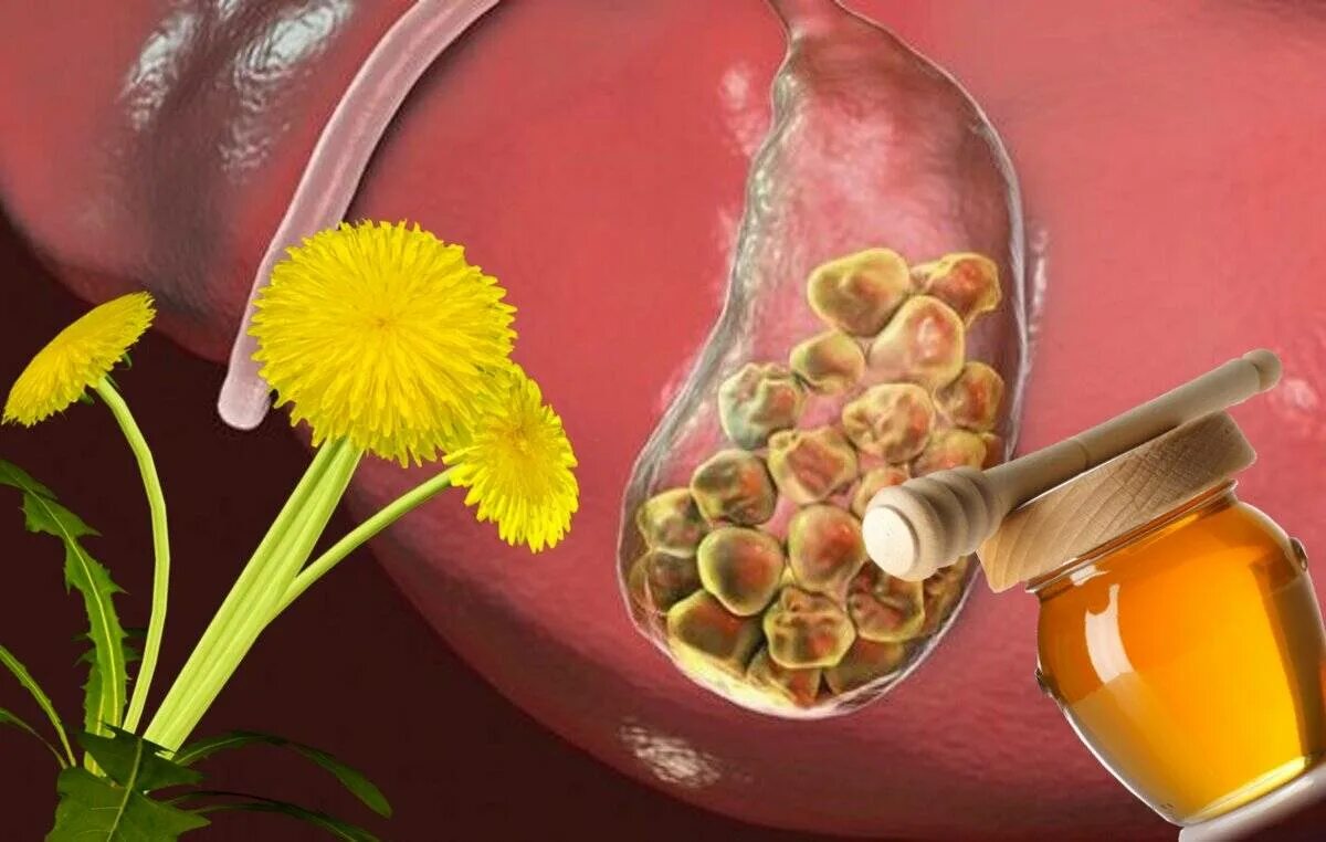 Желчь лечение народными средствами. ЖКБ камни желчного пузыря. Фитотерапия ЖКБ. Фитотерапия холецистита. Мед при желчи каменный болезни.
