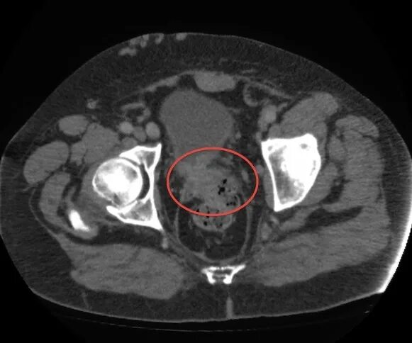 Опухоль Толстого кишечника на мрт. Опухоль прямой кишки на кт. Опухоль кишечника снимок мрт. Опухоль прямой кишки мрт. На кт видно опухоль