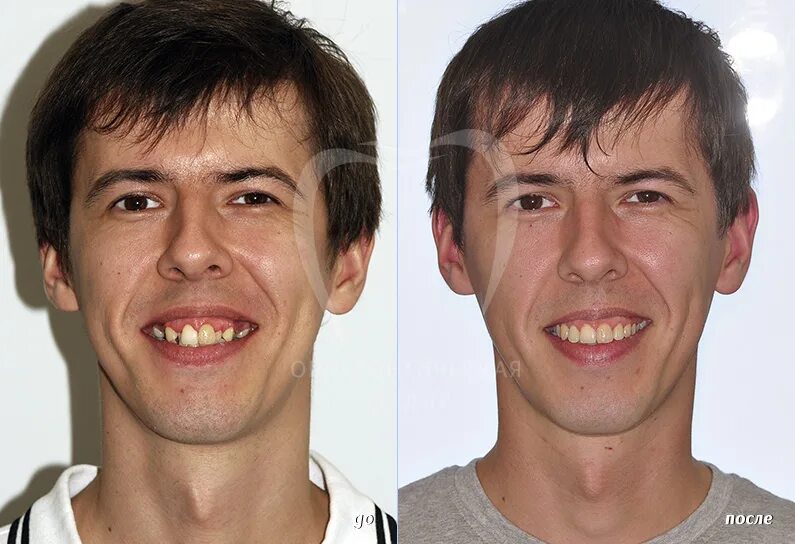 Брекеты до и после лицо асимметрия. Изменение лица до и после брекетов. Изменения после брекетов