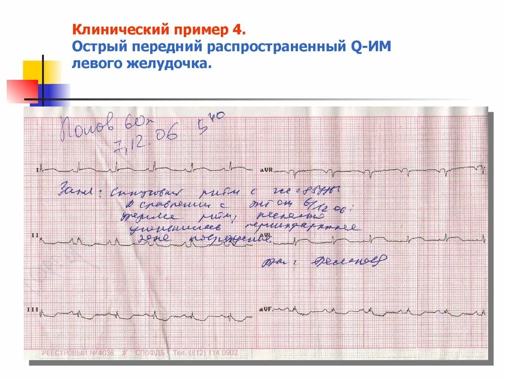 Ишемия на ЭКГ заключение. ЭКГ при ИБС стенокардия заключение. Заключение ЭКГ инфаркт миокарда пример. Заключение ЭКГ при ишемии. Заключения экг примеры