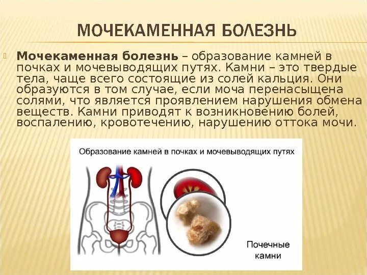 Боль при мочи у мужчин причины. Моче-КАМНЕННАЯ болезнь. Мочекаменная болезнь причины. Мочекаменная болезнь причины кратко.