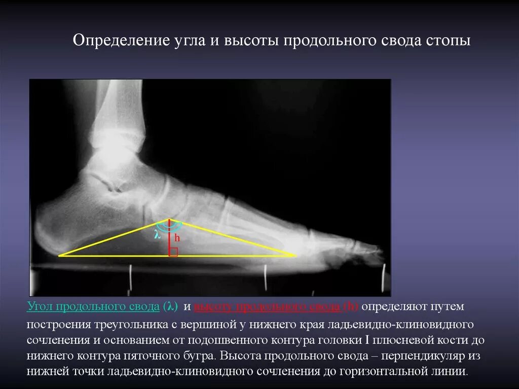 Плоскостопие 3 степени сколько градусов. Продольное плоскостопие норма рентген. Угол свода стопы на рентгенограмме. Продольное плоскостопие рентген степени. Плоскостопие 3 степени рентген.