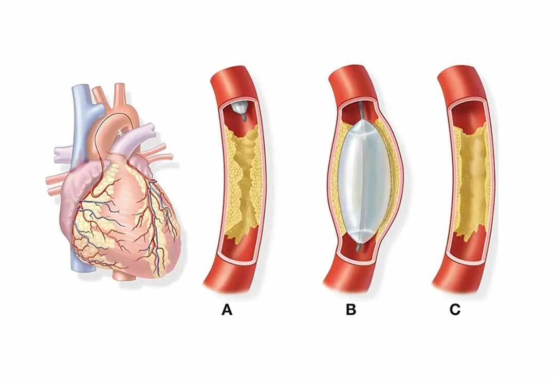 Расширение сердечного сосуда. Баллонная ангиопластика аорты. Коронарная ангиопластика и стентирование. Баллонная ангиопластика и стентирование. Операция стентирование сосудов сердца.