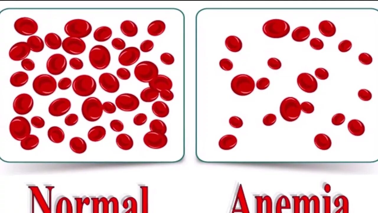 Анемия рисунок. Анемия норма. Норма и анемия картинка.