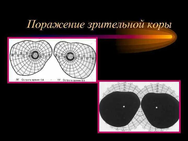 Выпадение полей зрения. Симметричные выпадения в полях зрения. Выпадение полей зрения причины. Выпадение полей зрения при инсульте.