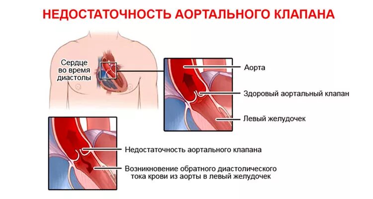 Осложнения стеноза