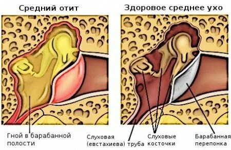 Симптомы отита у ребенка 1
