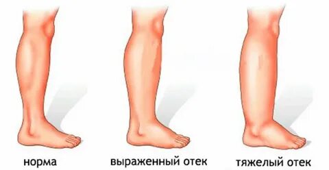 Отек ног на 36 неделе