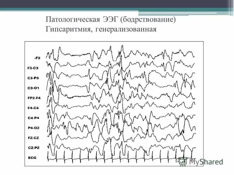 Ээг норма расшифровка. ЭЭГ (электроэнцефалограмма) головного мозга. Нормальная диаграмма ЭЭГ. Патологические ритмы ЭЭГ. ЭЭГ головного мозга график.