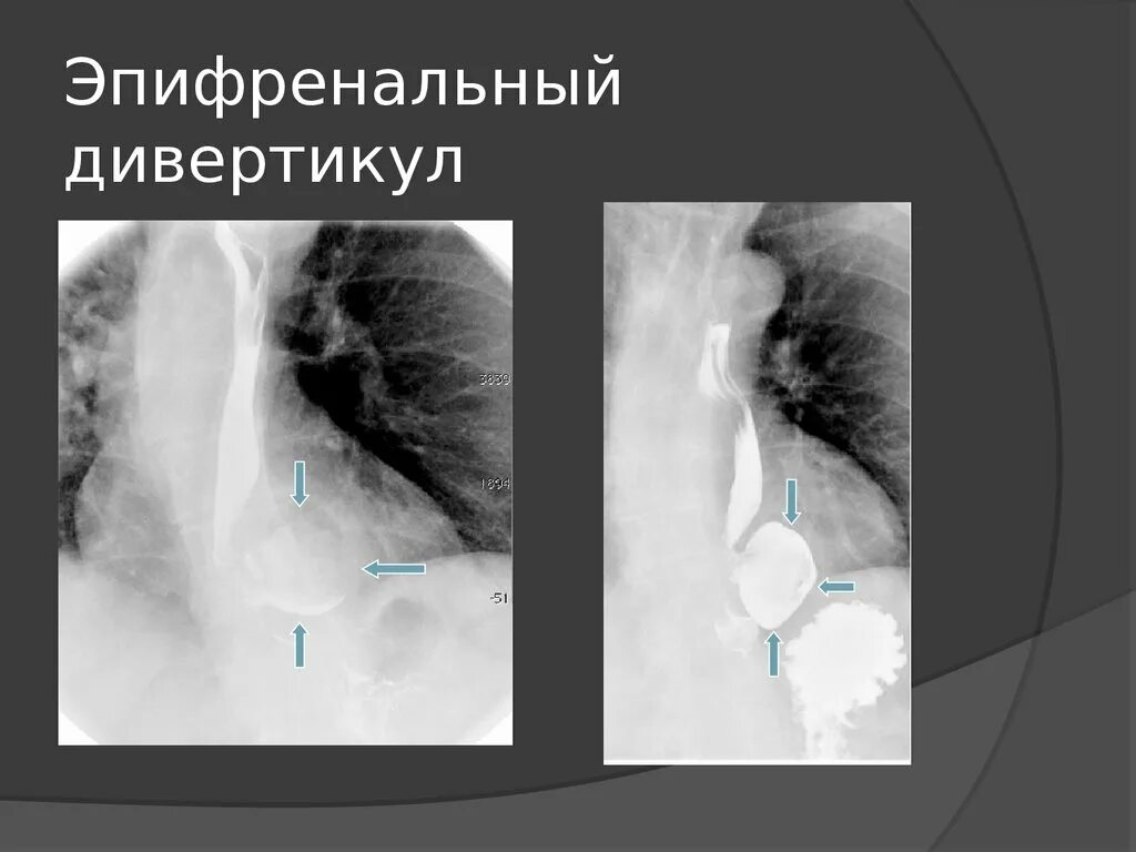 Эпифренальный дивертикул пищевода. Бифуркационные дивертикулы пищевода. Дивертикул пищевода рентген. Наддиафрагмальный дивертикул. Дивертикул осложнения