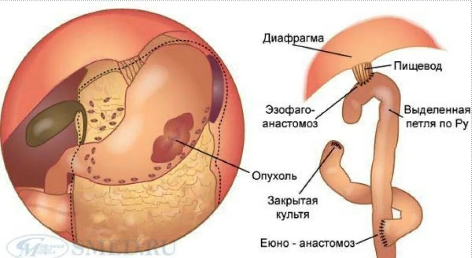 Новообразование в желудке. Опухоли оперированного желудка. Операция удаления опухоли желудка