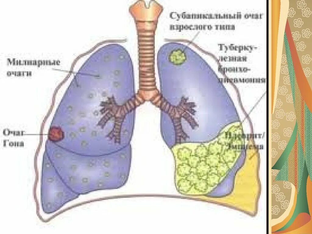 Туберкулёз лёгких картинки. Более легкое решение