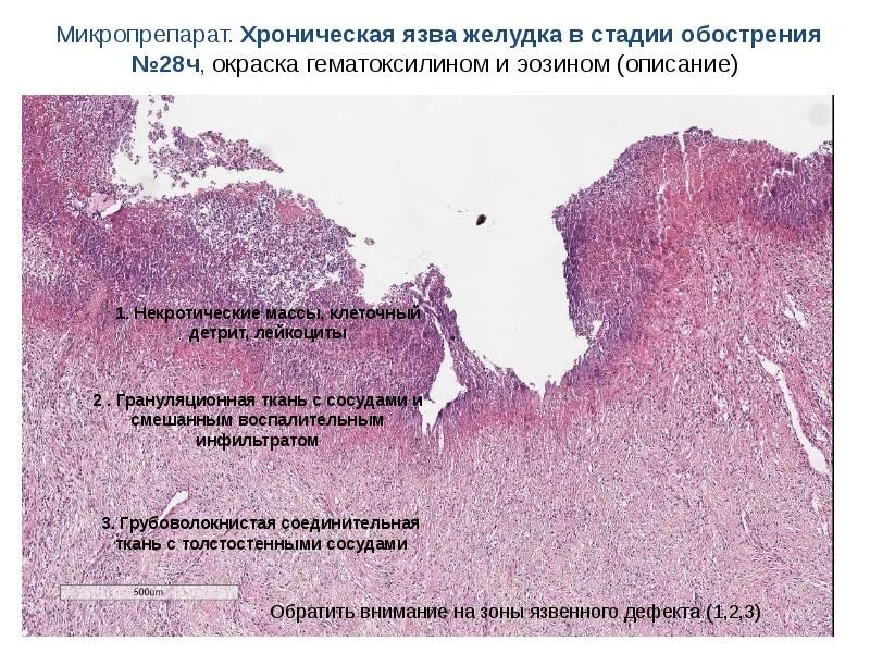 Хроническая язва желудка гистология. Хроническая язвенная болезнь желудка микропрепарат. Язвенная болезнь желудка микропрепарат. Хроническая язва желудка микропрепарат. Хроническое заболевание латынь