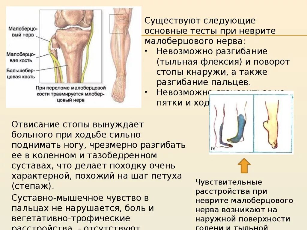 Малоберцовый нерв на стопе. Нейропатия малоберцового нерва симптомы. Поражение общего малоберцового нерва симптомы. Симптомы нейропатии малоберцового нерва. Нейропатия локтевого мкб