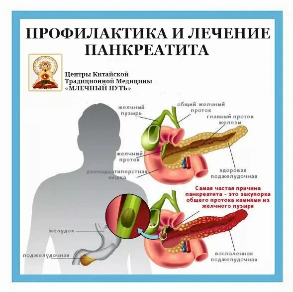Что такое панкреатит и как его лечить. Профилактика острого панкреатита. профилактика хронического панкреатита. профилактика при остром панкреатите. профилактика заболеваний поджелудочной железы.