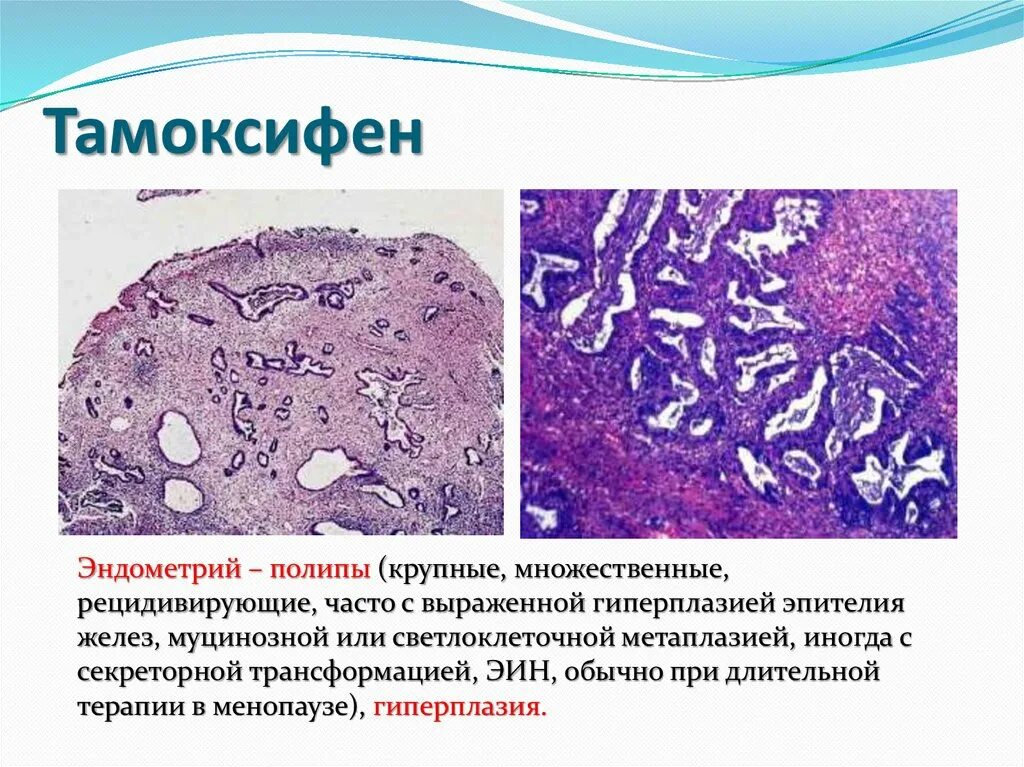 Тамоксифен и эндометрий. Норма эндометрия при приеме тамоксифена. Толщина эндометрия при гиперплазии. Гиперплазия прием тамоксифена.