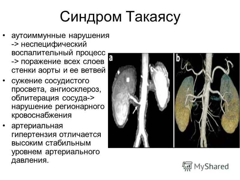 синдром дуги аорты