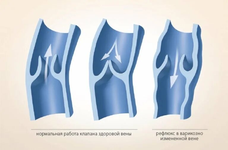 Венные клапаны при варикозе. Венозный клапан нижних конечностей. Венозные клапаны названия. Вены ног клапаны
