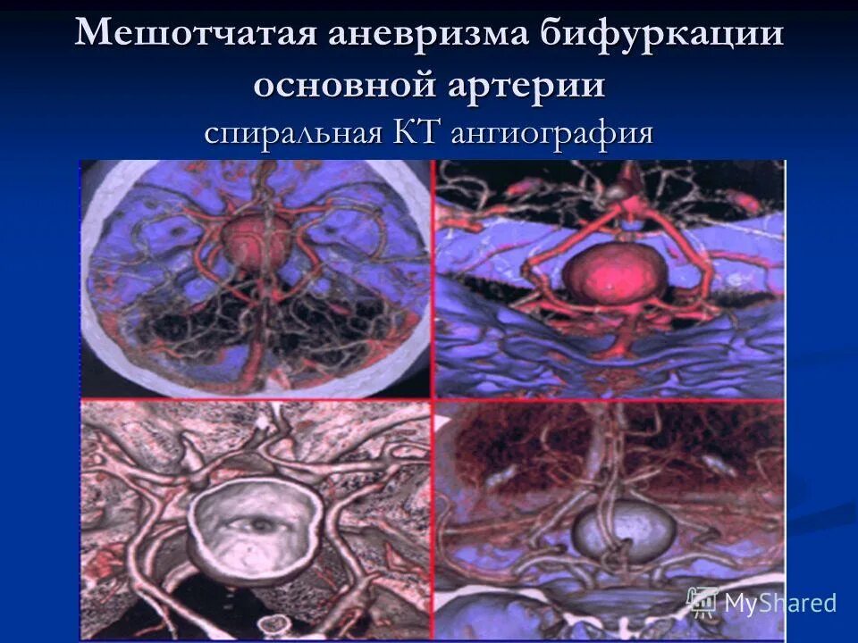 Аневризма гипофизарной артерии. Микроаневризма передней соединительной артерии. Аневризма основной артерии на кт. Мешотчатая аневризма вса. Фузиформная аневризма базилярной артерии.