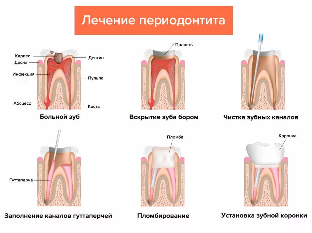 Полость страдать. Хронический периодонтит пульпит. Хронический фиброзный периодонтит схема. Схема этапы лечения воспаления корня зуба. Хронический периодонтит 2.5 зуба.
