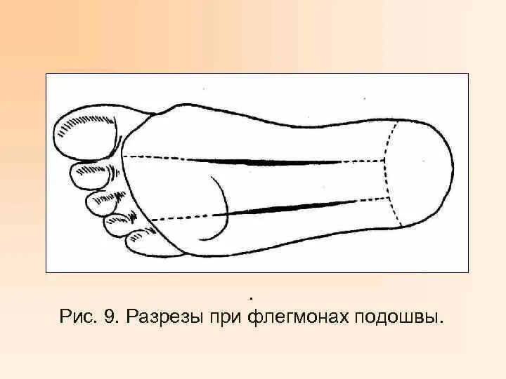 Линии разрезов при вскрытии флегмон предплечья. Вскрытие флегмон подошвы. флегмоны подошвы разрезы.
