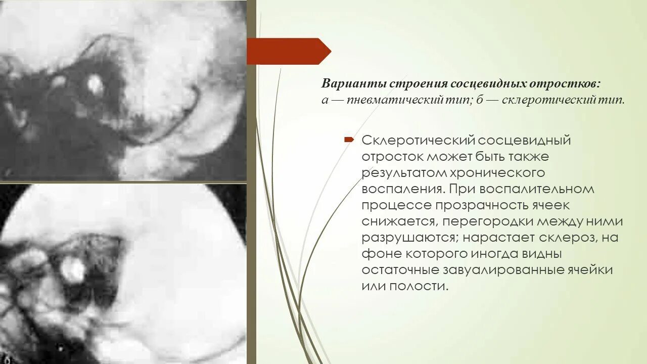 Утолщение слизистой сосцевидного отростка. Пневматический Тип строения сосцевидного отростка. Тип строения сосцевидного отростка височной кости. Мастоидит на рентгене по Шюллеру.